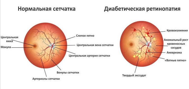 Ретинопатия диабетическая