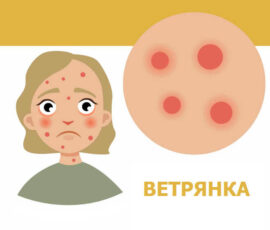 Ветрянка – ветряная оспа у детей и взрослых